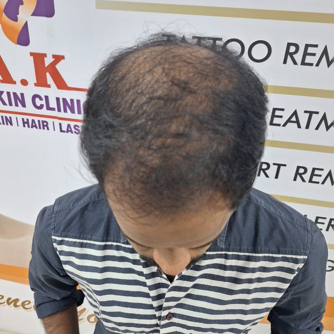Hairline Restoration Treatment - Before