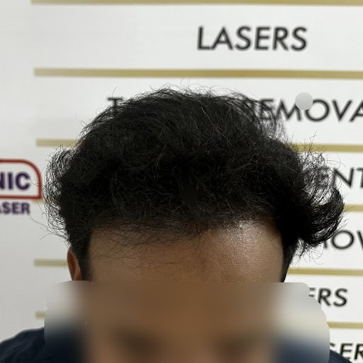 Hair Transplantation - After