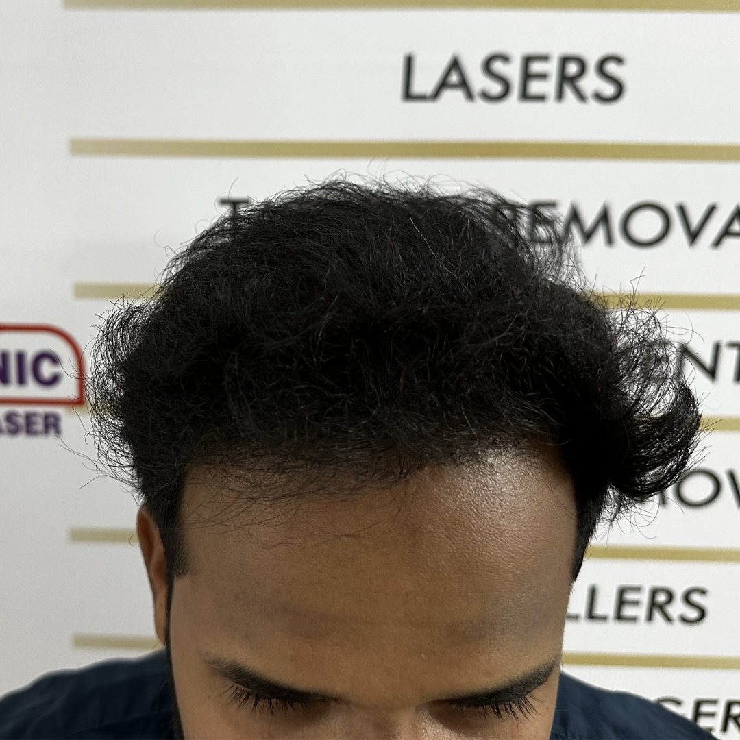 Hairline Restoration Treatment - After