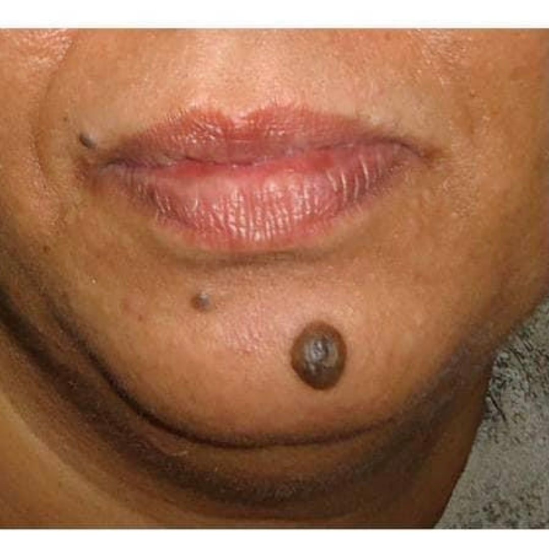 Mole and Wart Treatment - Before