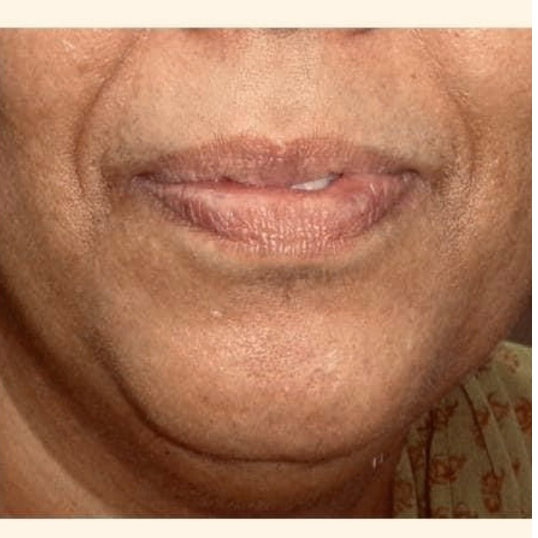 Mole and Wart Treatment - After