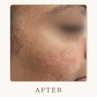 Acne Marks Treatment - After