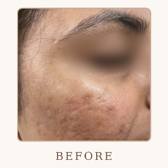 Acne Marks Treatment - Before