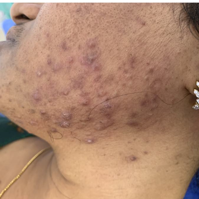 Acne Pimple Treatment - Before