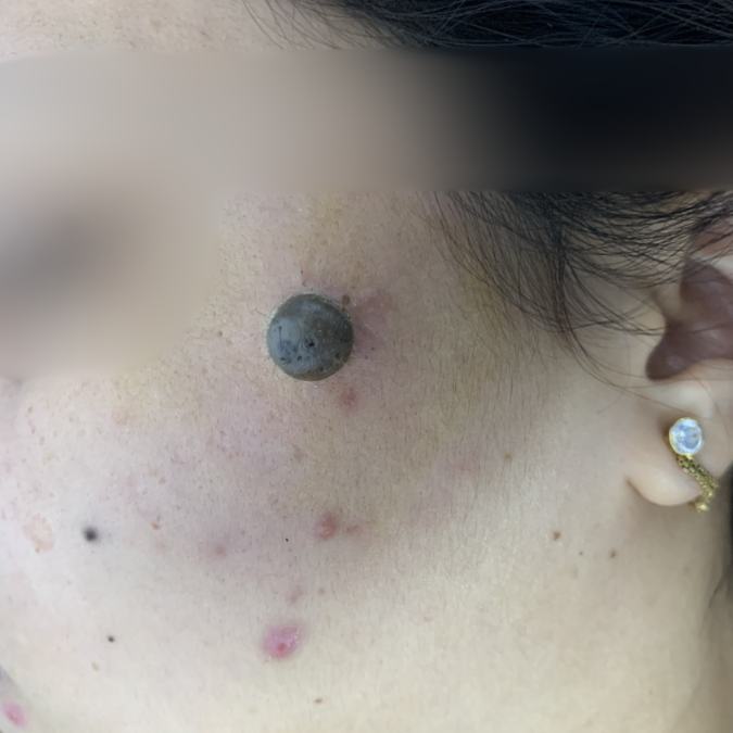 Mole Treatment - Before