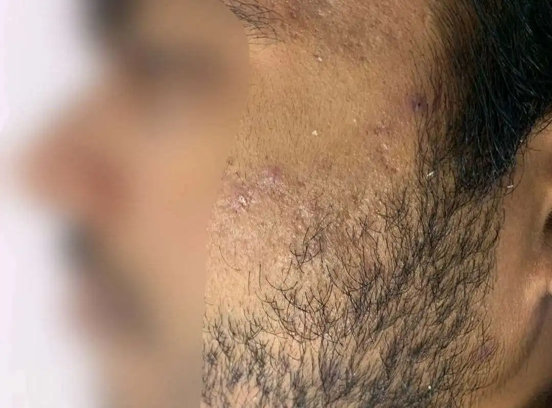 Acne Scar Treatment - After