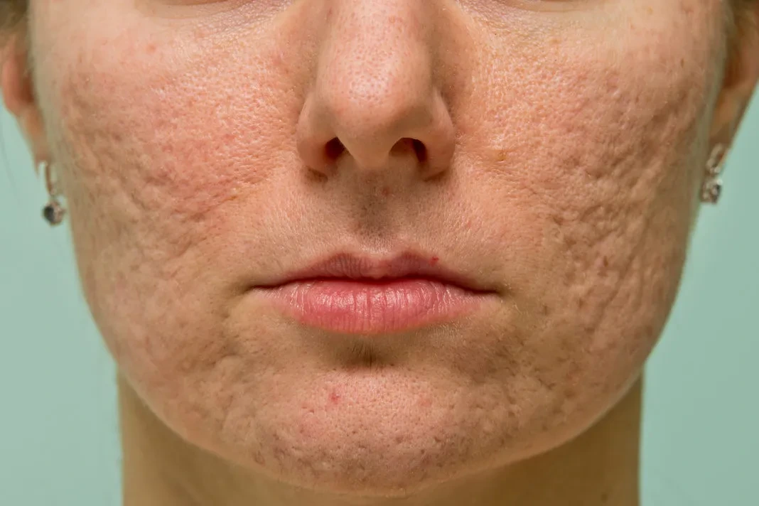 Acne Scar Treatment: Best Options to Smooth and Restore Your Skin
