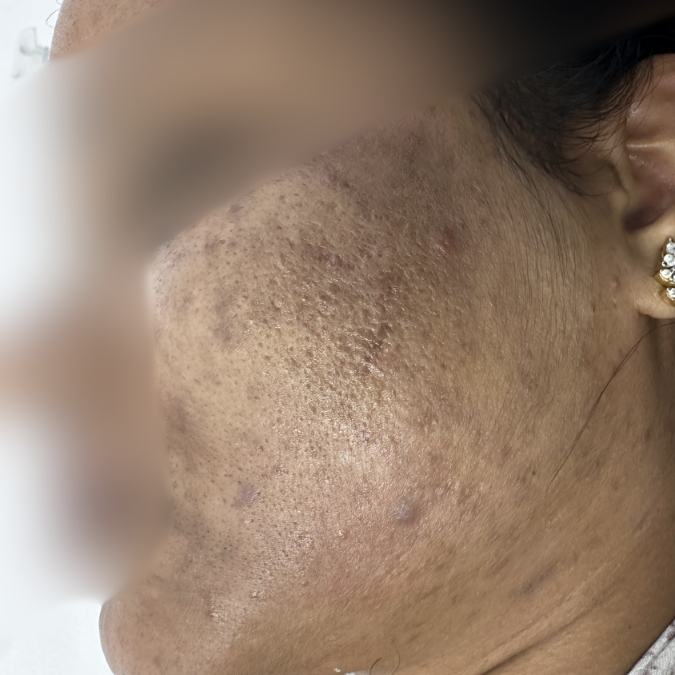 Acne Pimple Treatment - After