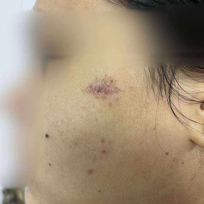Mole Treatment - After