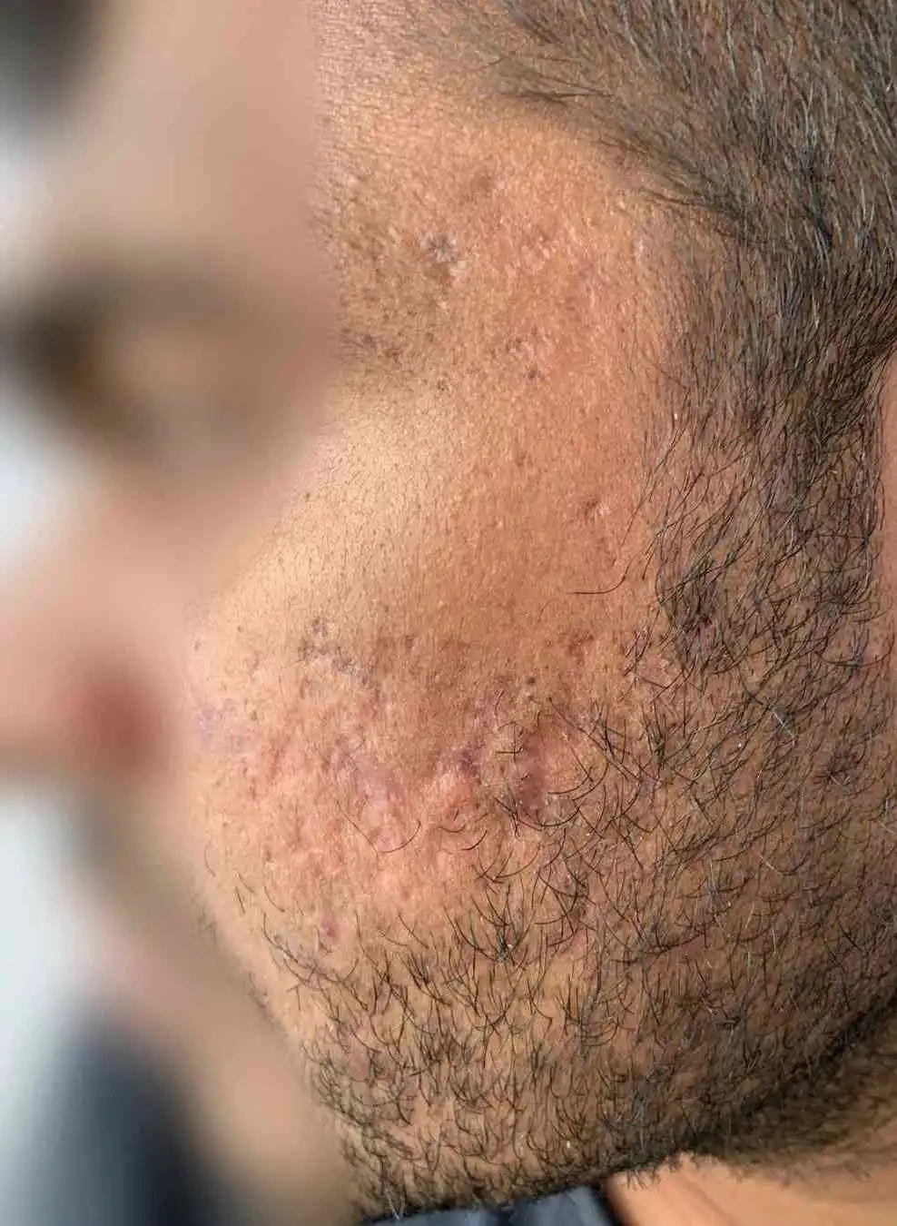 Acne Scar Treatment - Before