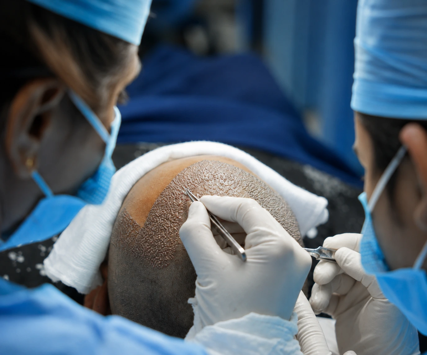 BIO FUE HAIR TRANSPLANT