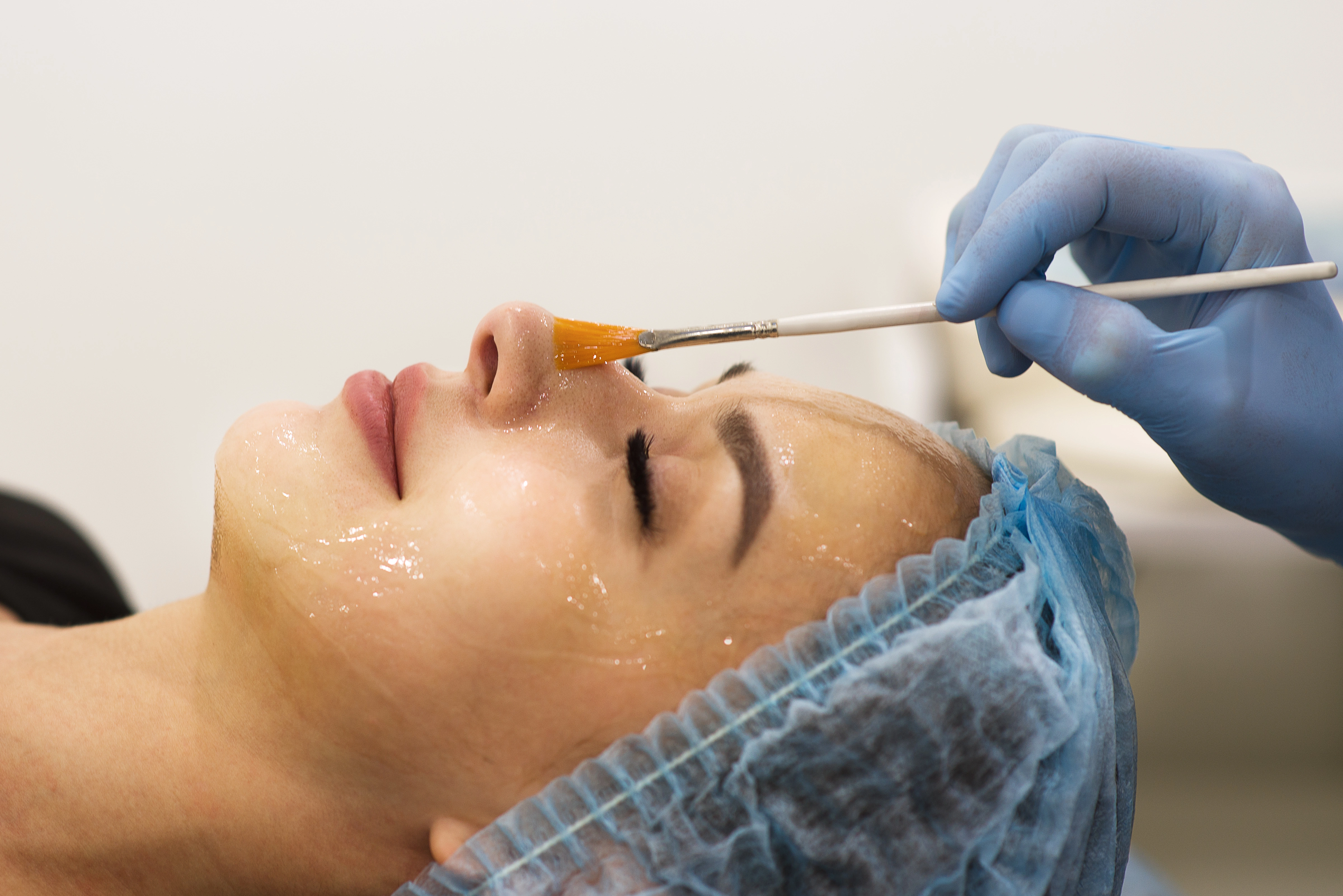 Chemical Peels