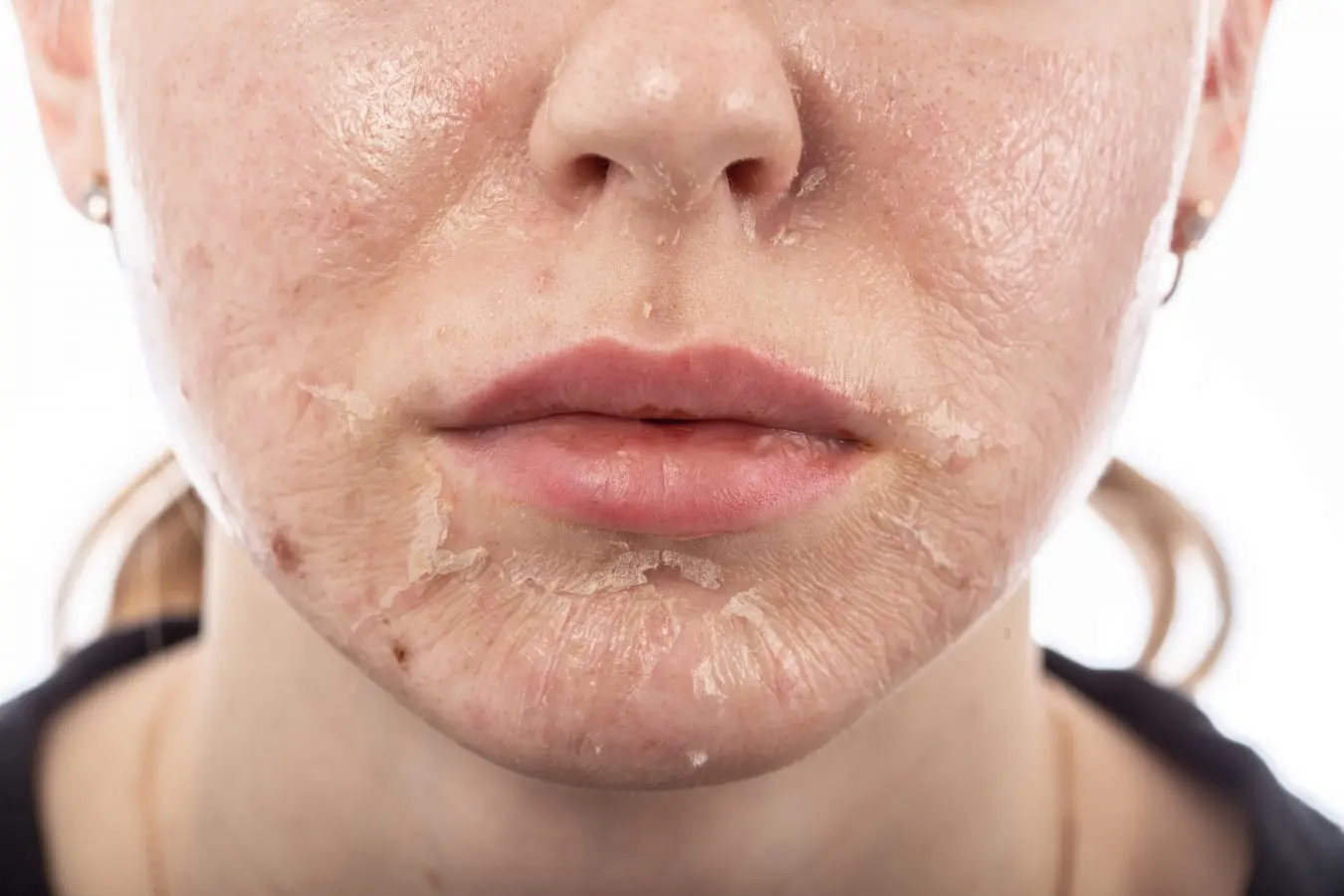 Chemical Peel Treatment: Brighter, Smoother Skin the Right Way