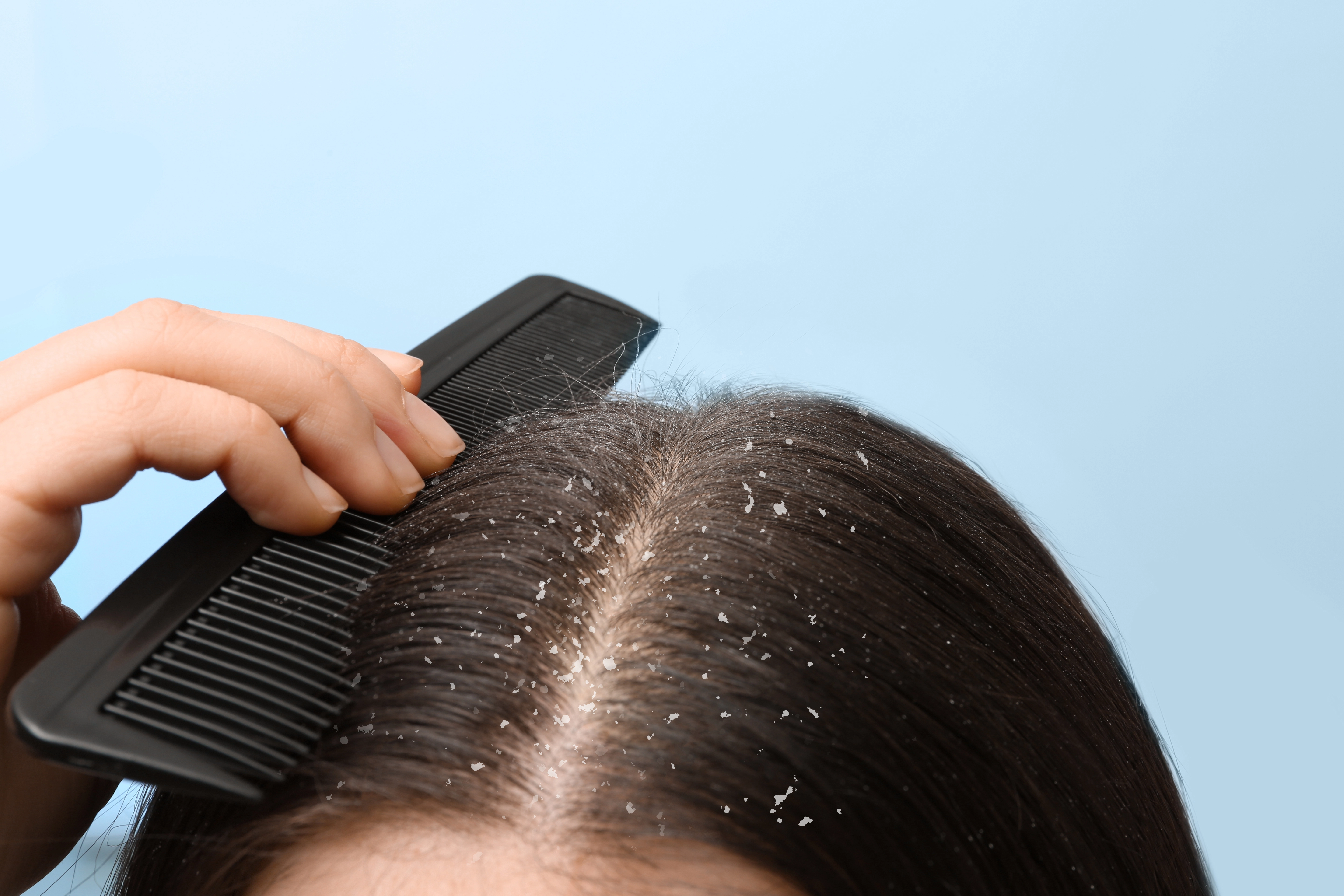 Dandruff
