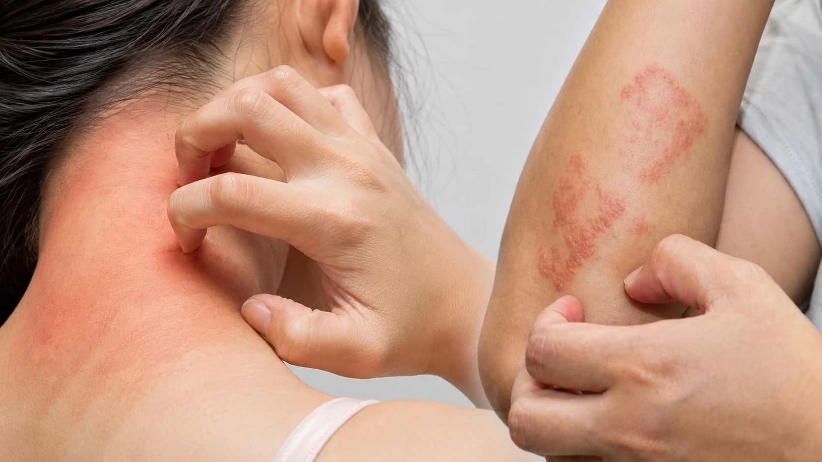 Fungal Infections
