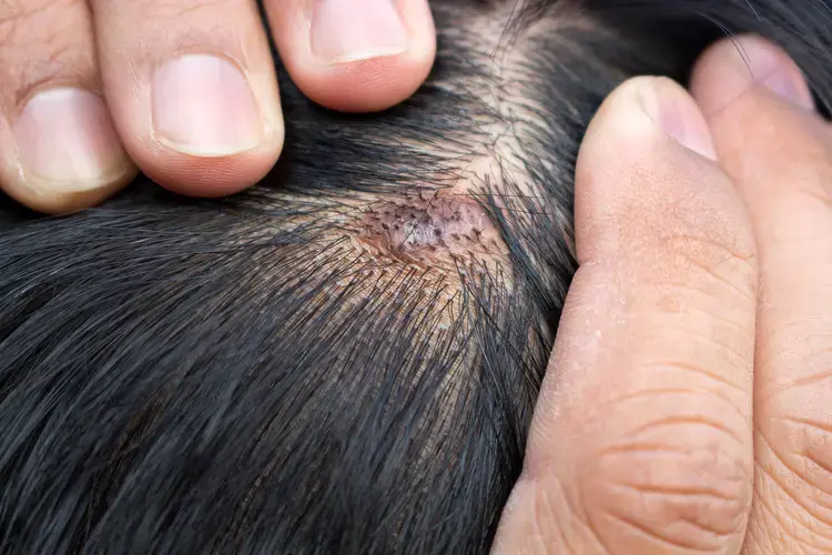 Scalp / Hair Infections
