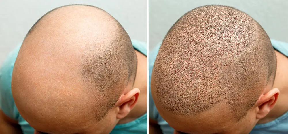 Hair Transplant for Scalp Baldness: A Complete Guide to FUE Results