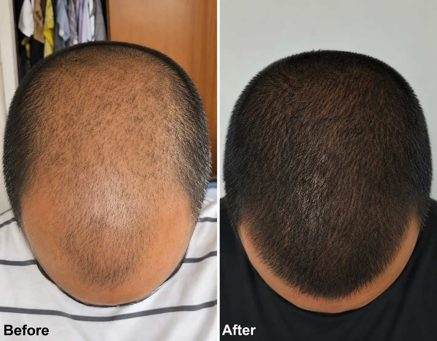 Hair Transplantation For Scalp