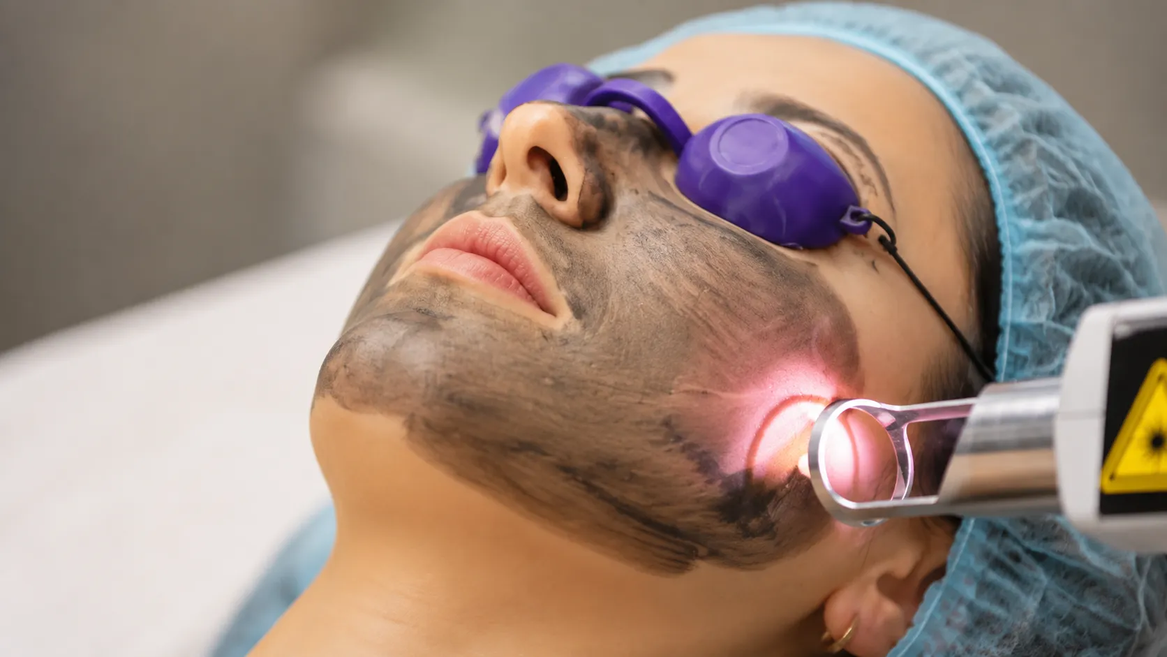 Laser for pigmentation