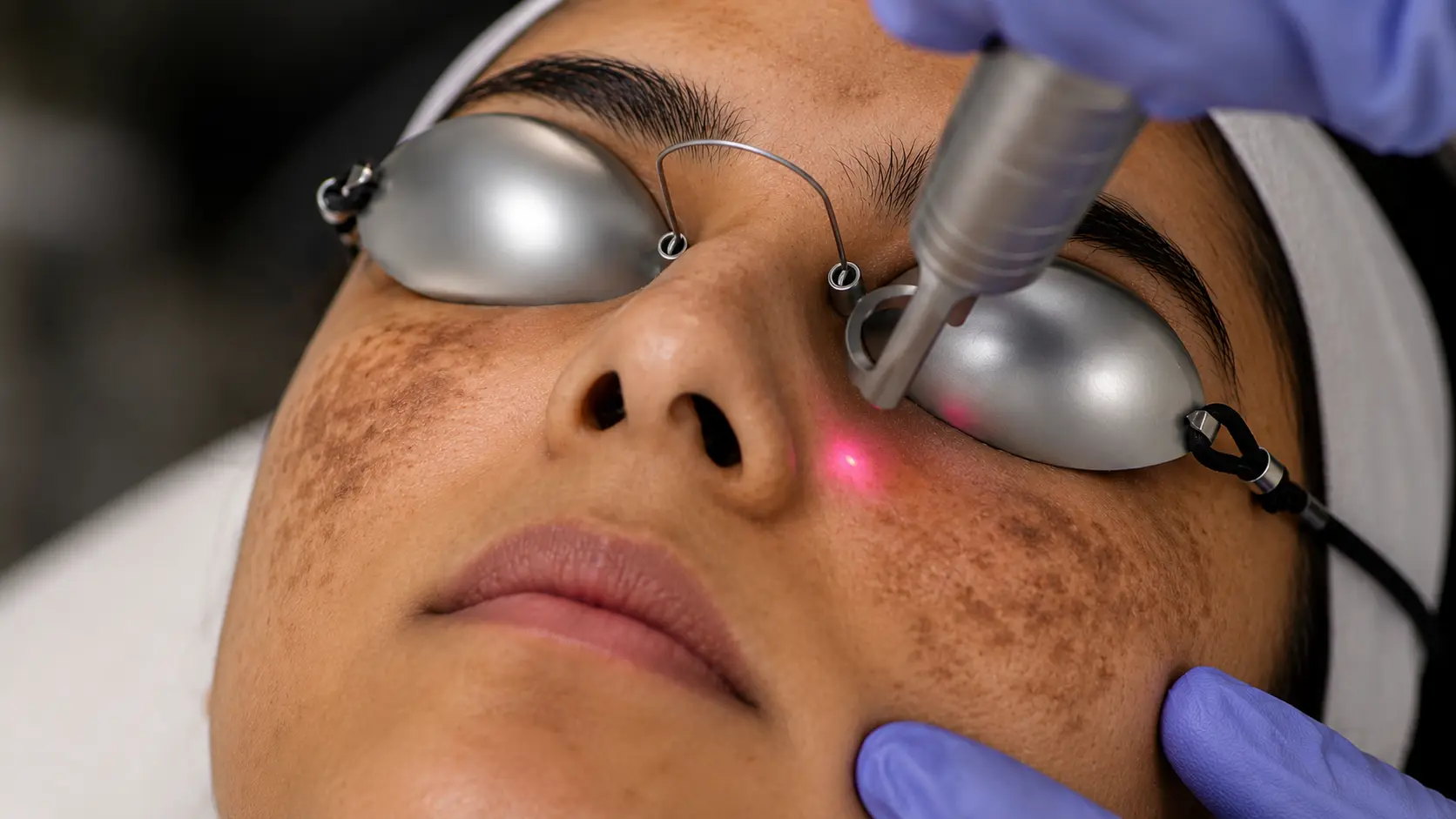 Laser for pigmentation