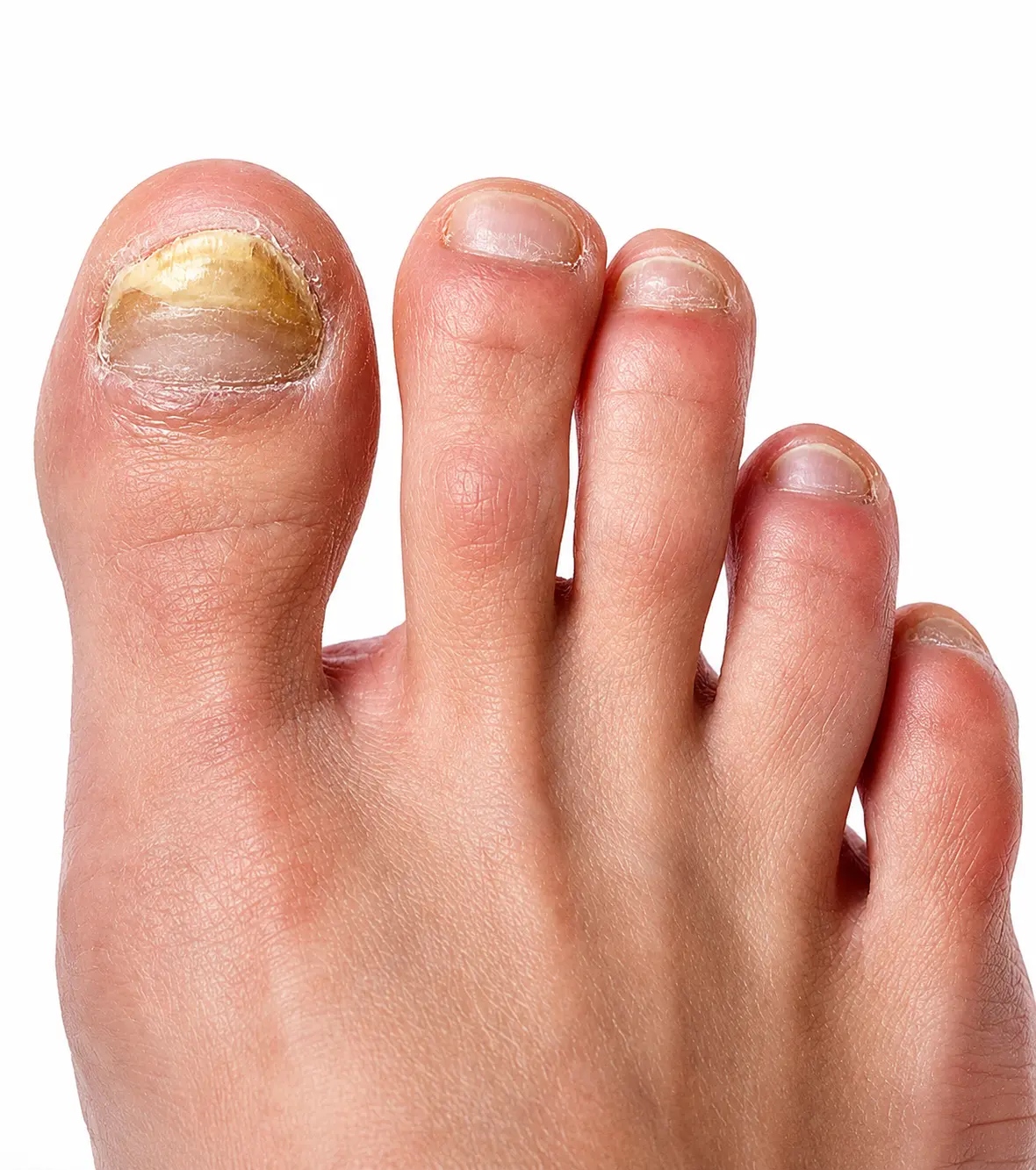 Nail Disorders