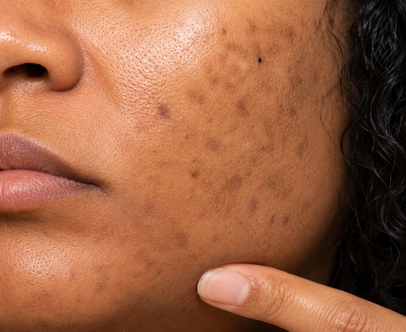 Pigmentation / Dark Spots