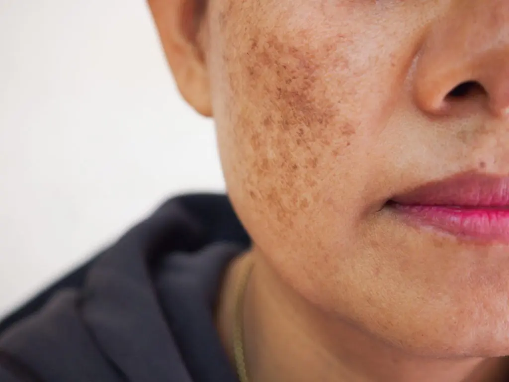 Pigmentation and Dark Spots: Causes, Treatments, and Long-Term Solutions