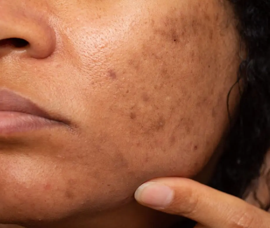 Pigmentation and dark spot treatment