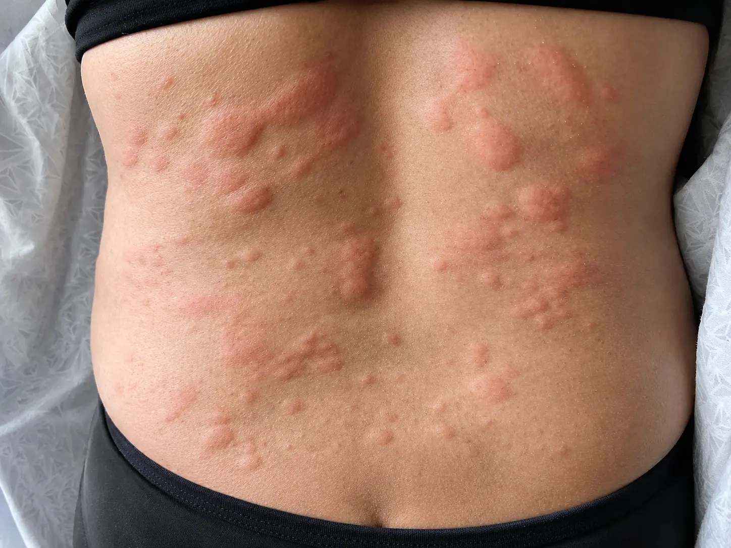 Rashes