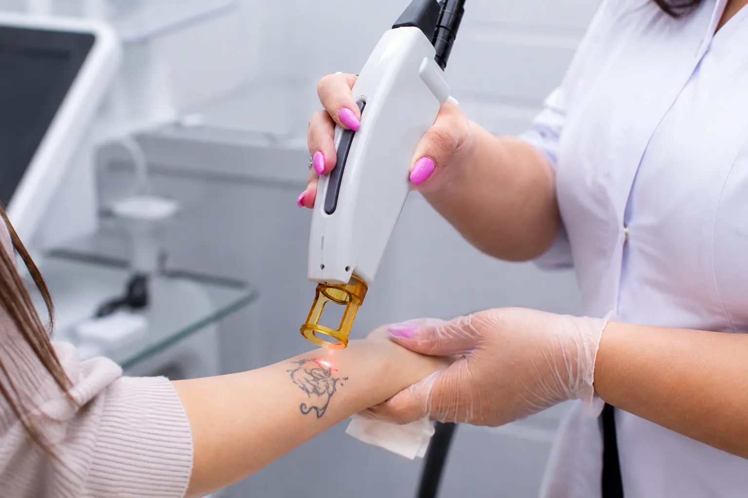  Laser Tattoo Removal