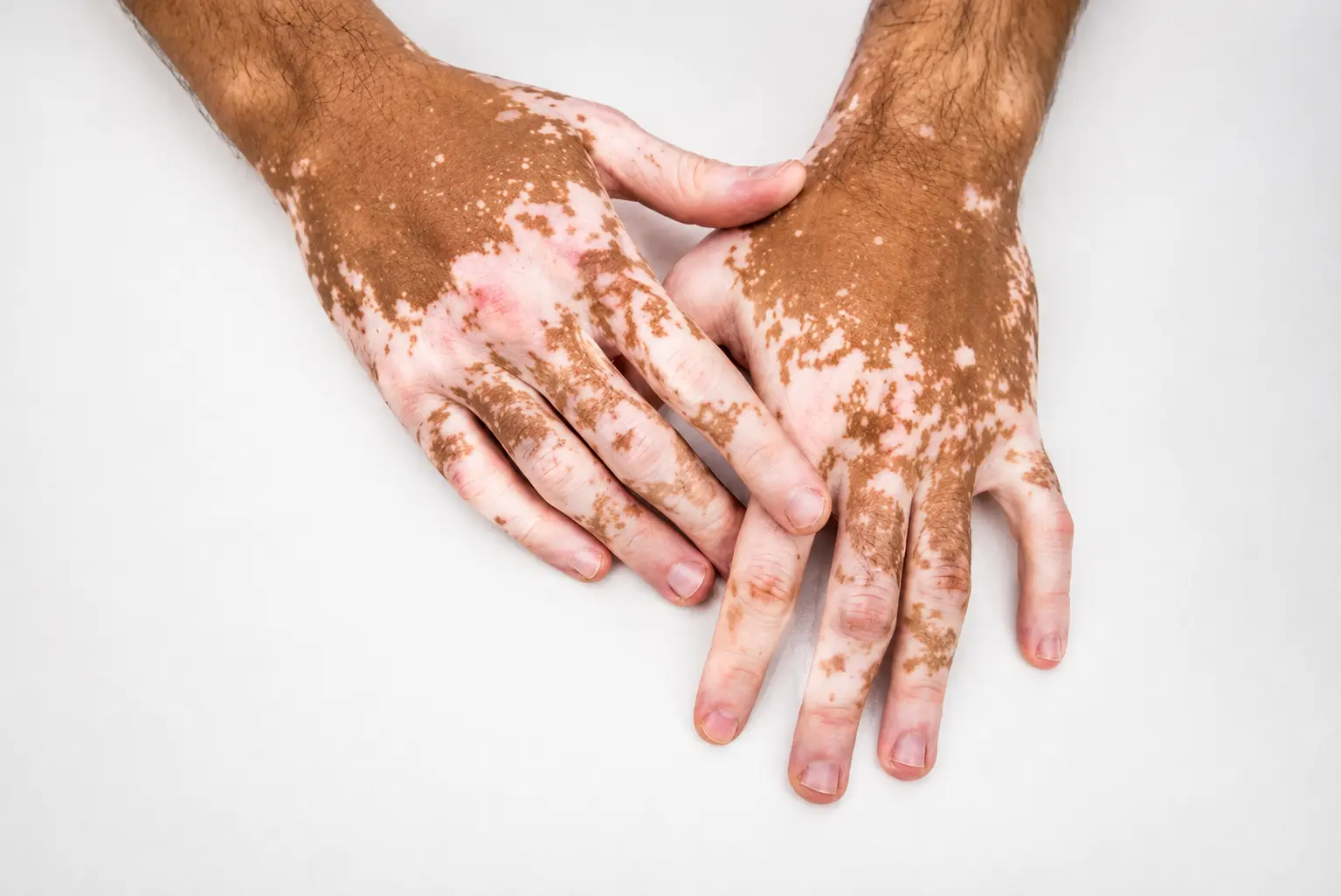 Vitiligo