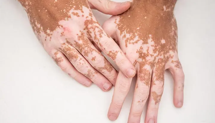 Vitiligo Treatment: Causes, Symptoms and Repigmentation Options
