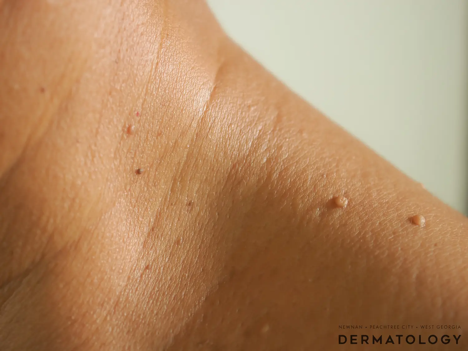 Wart, Mole, and Skin Growth Removal in Hyderabad: Safe and Precise Procedures