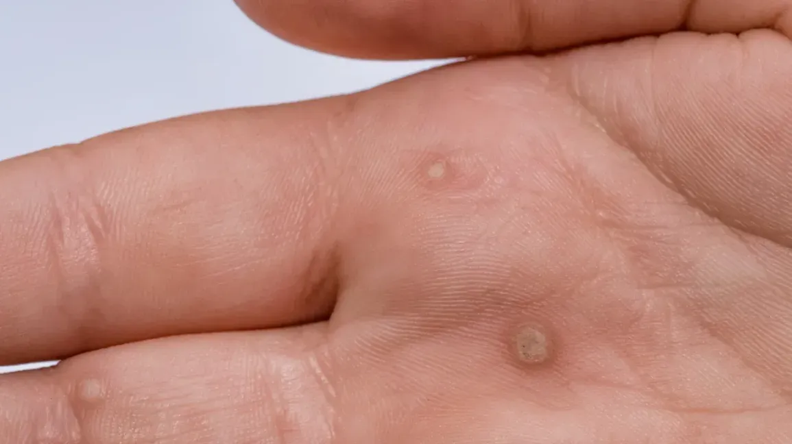 Warts / Moles / Skin Growths Removal